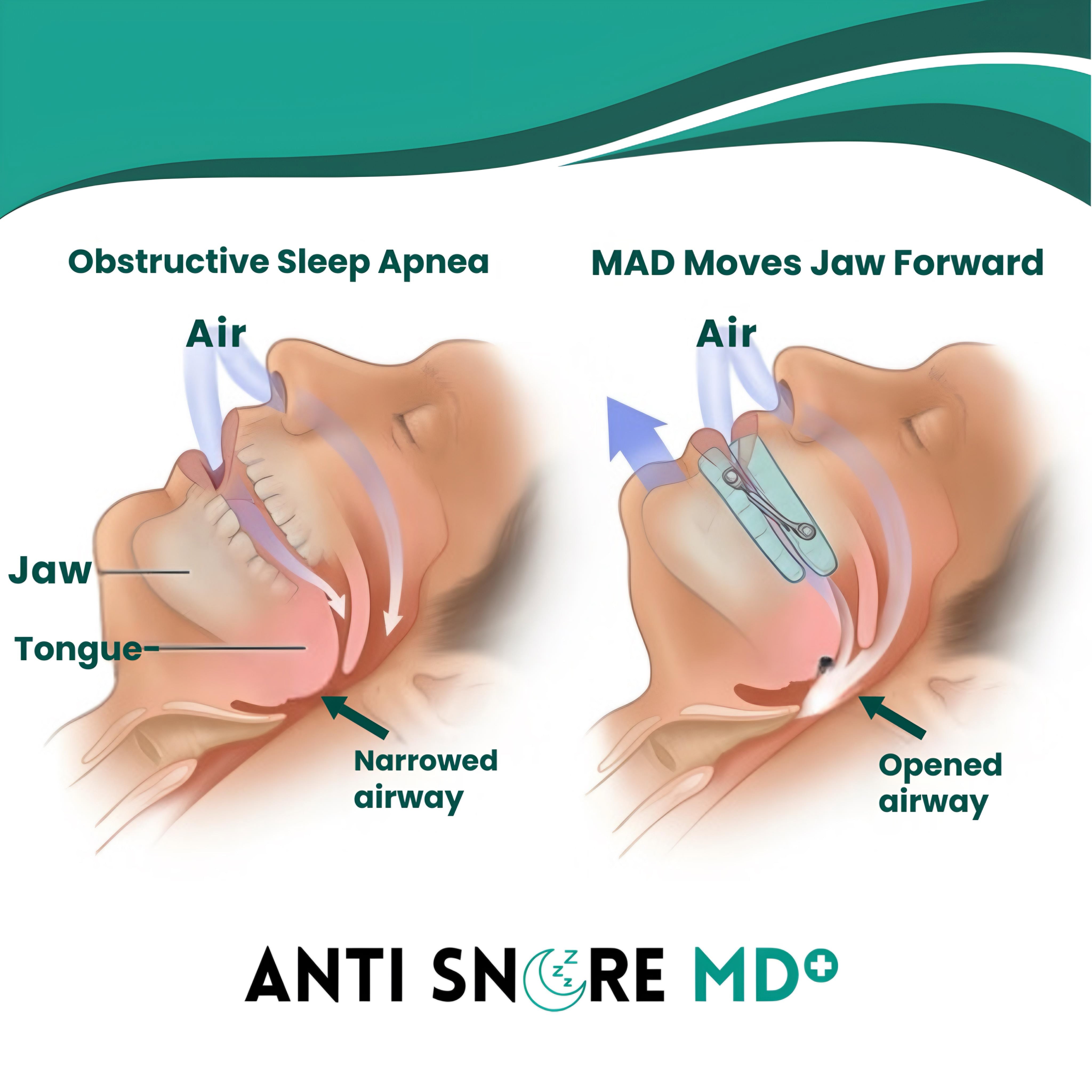 Anti Snore MD Adjustable Mouthpiece